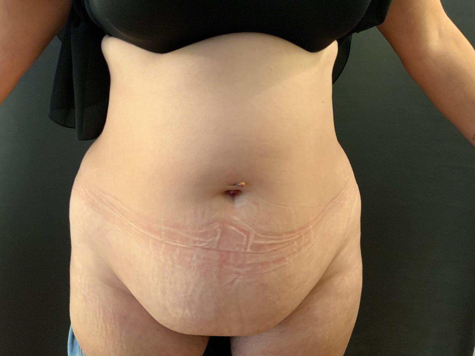 Résultat d'abdominoplastie puis évolution de la silhouette après reprise progressive du sport (photographie 1 sur 6)