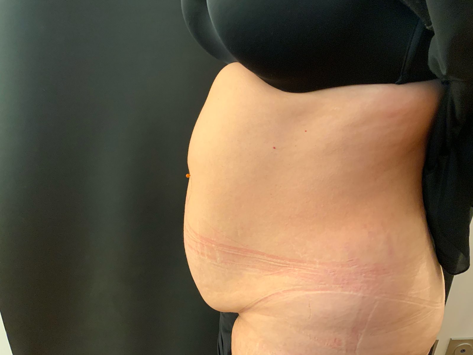 Résultat d'abdominoplastie puis évolution de la silhouette après reprise progressive du sport (photographie 2 sur 6)