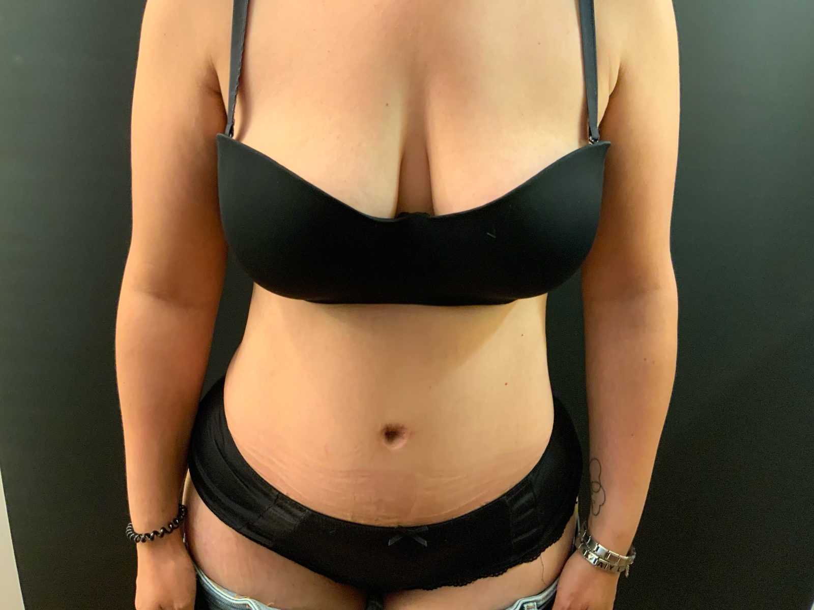 Résultat d'abdominoplastie puis évolution de la silhouette après reprise progressive du sport (photographie 3 sur 6)