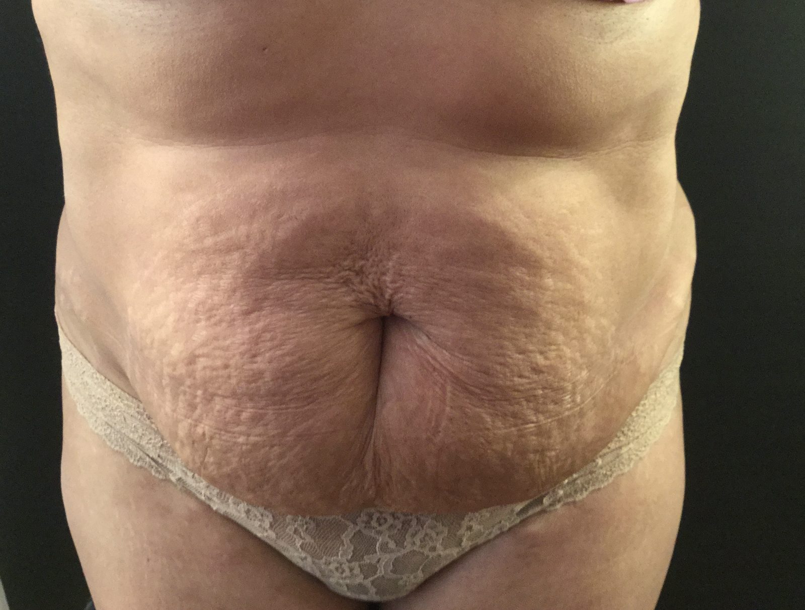 Photographie clinique d'un ventre post-partum avec excès cutané et distension de la paroi (photographie 1 sur 3)