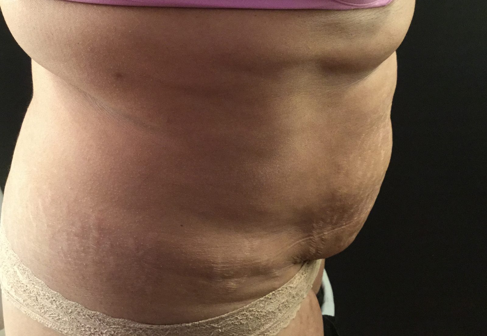 Photographie clinique d'un ventre post-partum avec excès cutané et distension de la paroi (photographie 2 sur 3)