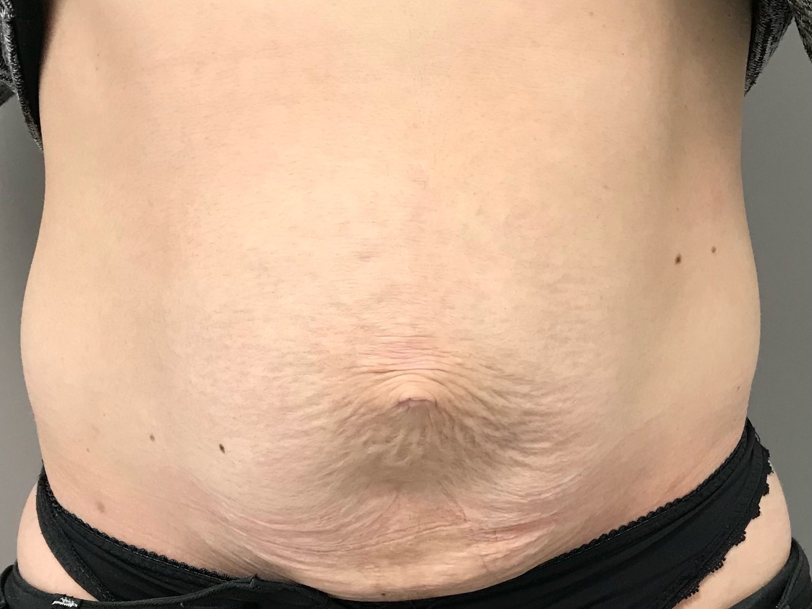 Photographie clinique de la paroi abdominale après grossesse (photographie 1 sur 4)