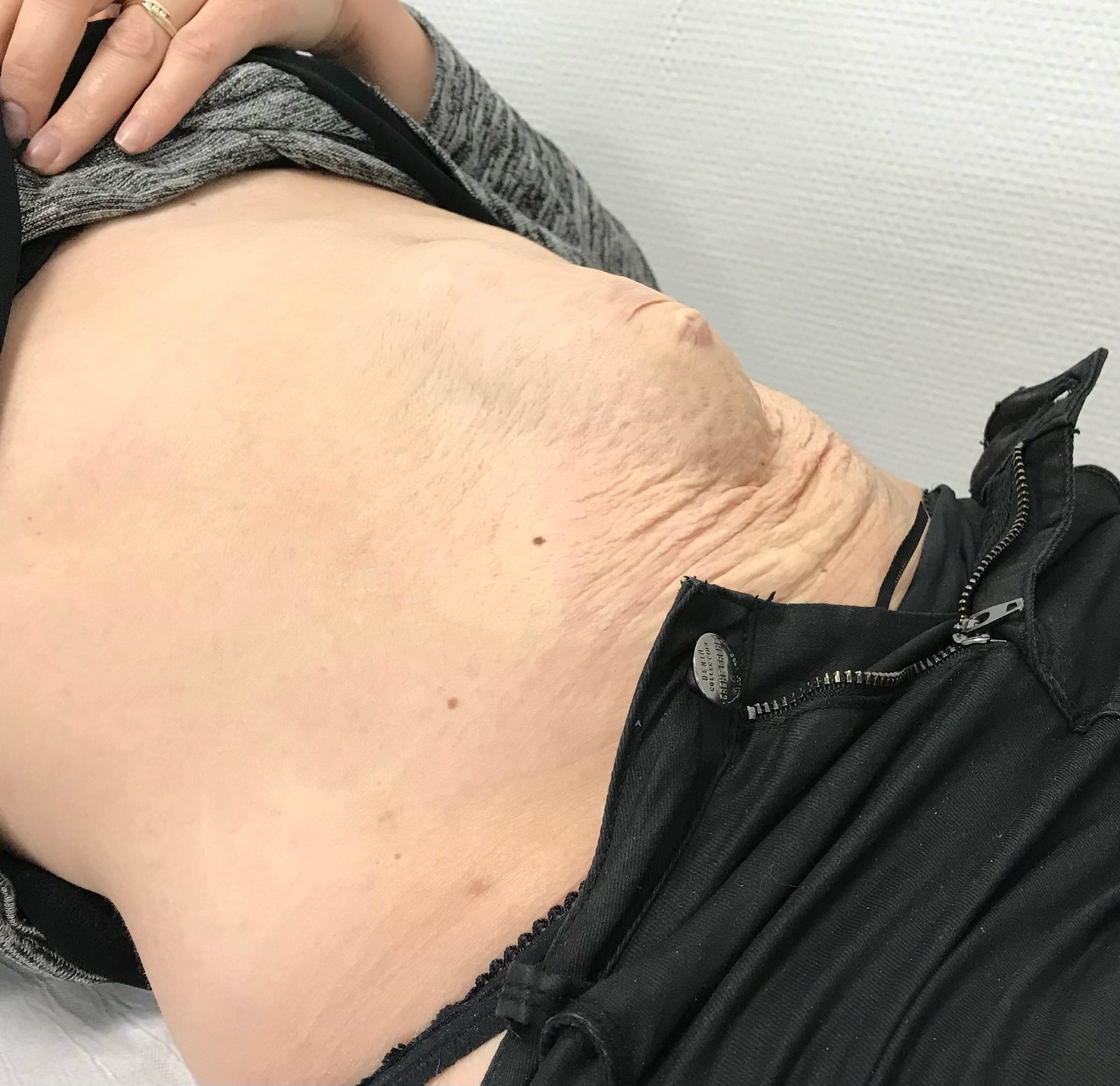 Photographie clinique d'un diastasis des muscles grands droits après grossesse (photographie 2 sur 2)