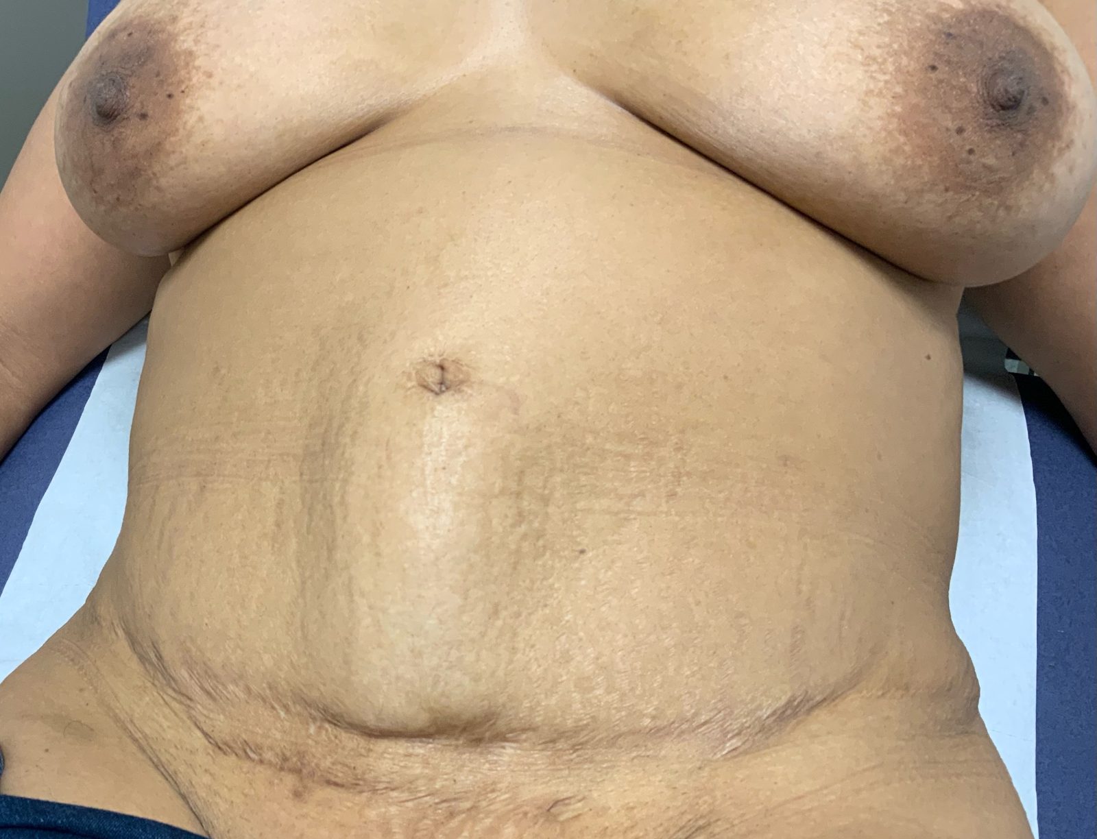 Diastasis résiduel et ventre bombé après une première abdominoplastie (photographie 1 sur 2)
