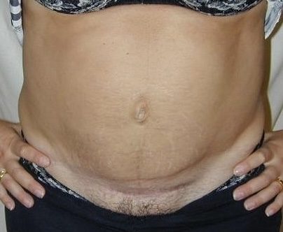 Correction secondaire d'un diastasis résiduel après plastie abdominale (photographie 1 sur 4)